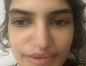 Secondary Nose Job Rhinoplasty after Cleft Lip Nose and Fat Grafting at Best Cosmetic surgery Egypt