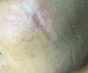 Stem Cells and Nanofat grafting for deep face and cheek scar at Best Plastic Surgery Egypt