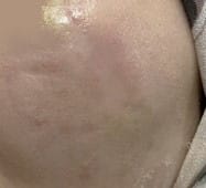 Stem Cells and Nanofat grafting for deep face and cheek scar at Best Cosmetic Surgery Egypt