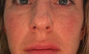 Juvederm Filler to soften the deep nasolabial folds at Best Aesthetic Surgery Egypt