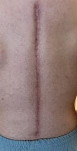 Wide gaped Scar in back treated by Scar Revision and Botox at Best Plastic Surgery Egypt