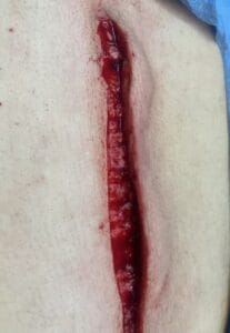 Wide gaped Scar in back treated by Scar Revision and Botox at Best Aesthetic Surgery Egypt
