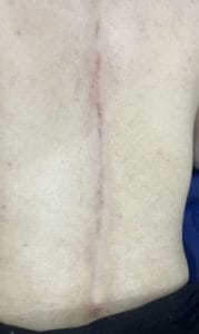 Wide gaped Scar in back treated by Scar Revision and Botox at Best Cosmetic Surgery Egypt