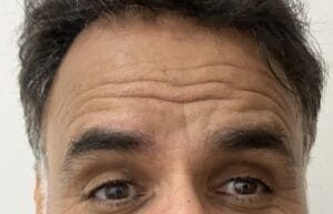 Deep Dynamic Wrinkles in the Forehead and Crow's Feet treated by Dysport at Best Cosmetic Surgery Egypt