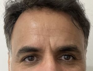 Deep Dynamic Wrinkles in the Forehead and Crow's Feet treated by Dysport at Best Aesthetic Surgery Egypt