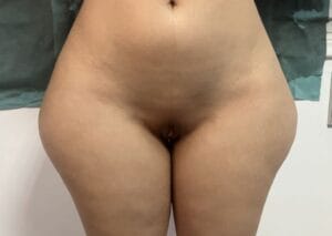 Smart High Definition Vaser Liposuction for Wide Broad Hips and Cellulite filling at Best Plastic Surgery Egypt