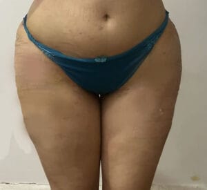 Smart High Definition Vaser Liposuction for Wide Broad Hips and Cellulite filling at Best Cosmetic Surgery Egypt