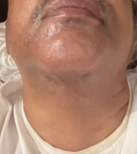 Submental Neck Lift and Neck Liposuction and Platyzmaplasty at Best Plastic Surgery Egypt