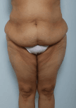 360 degree liposuction and Tummy tuck and Thigh Lift after Weight loss at best Plastic Surgery Egypt