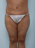 360 degree liposuction and Tummy tuck and Thigh Lift after Weight loss at best Aesthetic Surgery Egypt