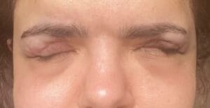 Eyelid shortening after Blepharoplasty treated by Tissue Expansion at Best Cosmetic Surgery Egypt