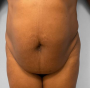 360 degree liposuction for overhanging belly and flank and waist and back at Best Plastic Surgery Egypt
