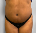 360 degree liposuction for overhanging belly and flank and waist and back at Best Cosmetic Surgery Egypt