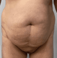 Overhanging Belly and bulging Waist for Tummy Tuck and 360 liposuction at Best Plastic surgery Egypt