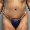 Overhanging Belly and bulging Waist for Tummy Tuck and 360 liposuction at Best Aesthetic surgery Egypt