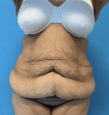 Extended Tummy Tuck and 360 Liposculpture with Waist Liposuction at Best Plastic Surgery Egypt