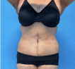 Extended Tummy Tuck and 360 Liposculpture with Waist Liposuction at Best Cosmetic Surgery Egypt