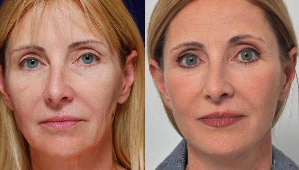 Face Lift and Neck Lift and Eyelids Full face Lift and Mid face Lift and Brow Lift and Neck Lift are performed by the Best plastic Surgery at the Nile Cosmetic Center