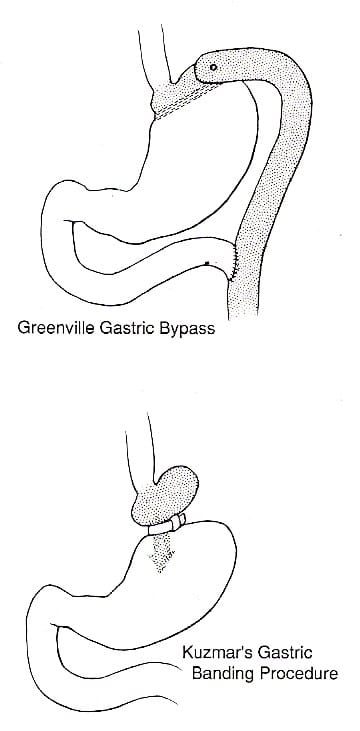 Morbid Obesity, Bariatric Surgery, Sleeve Gastrectomy, Best Plastic Surgery, Nile Cosmetic Center