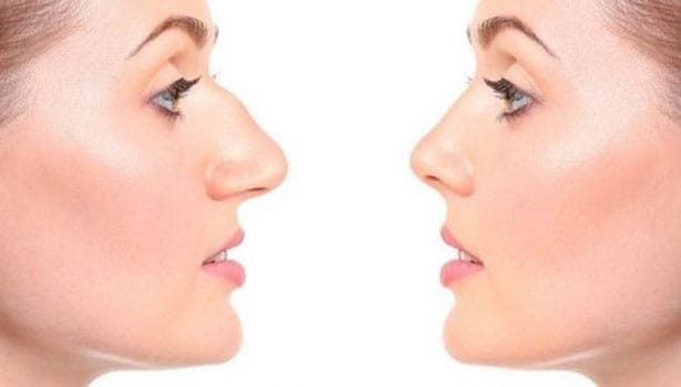 Nose-job-Rhinoplasty Full Rhinoplasty and Tip Rhinoplasty and Dorsal Hump Rhinoplasty at Best Cosmetic Surgery in Egypt