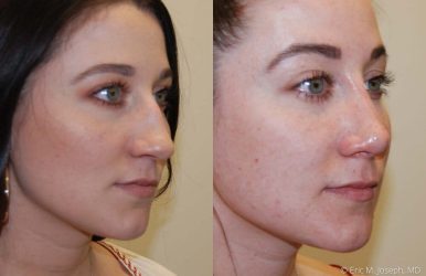 Rhinoplasty and Nose Job Best Plastic surgery offers the best Rhinoplasty and Best Nose job surgery in Egypt and in the Middle East with innovations by Prof Wilson